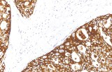 Anti-HER2/neu CE/IVD for IHC - Gynecological pathology