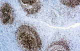 Anti-CD23 CE/IVD para IHC - Hematopatología