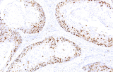 Anti-Ki-67 CE/IVD para IHC - Patología ginecológica
