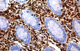 Anti-Vimentina CE/IVD para IHC - Patología ginecológica