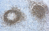 Leucemia a cellule capellute
