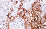 Anti-CA-125 CE/IVD voor IHC - Gynaecologische pathologie
