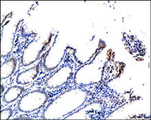 P16-INK4 staining in human colon cancer. Paraffin-embedded human colon cancer is stained with p16-INK4 Antibody (Cat. No. 250804) used at 1:200 dilution.