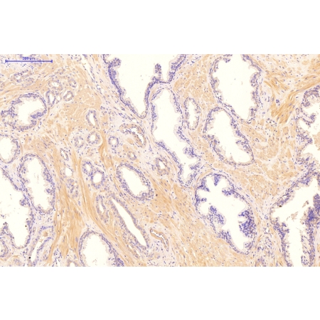 Human Diseased Prostate