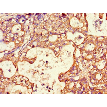 Human gastric cancer