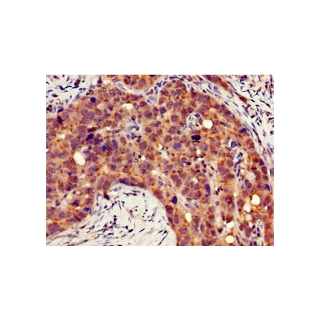 Human pancreatic cancer