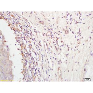 Human breast carcinoma