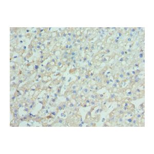 Human liver cancer