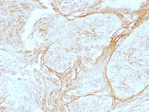 Formalin-fixed, paraffin-embedded human Lung Carcinoma stained with Tenascin C Mouse Monoclonal Antibody (SPM319).