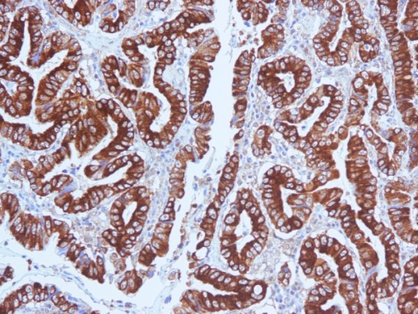 Formalin-fixed, paraffin-embedded human Gastric Carcinoma stained with MUC5AC Mouse Monoclonal Antibody (CLH2). Courtesy of Dr. Leonor David, IPATIMUP and Medical Faculty, University of Porto, Portugal.