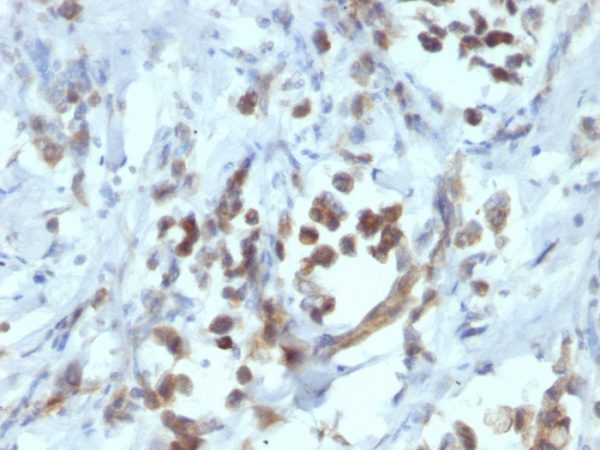 Formalin-fixed, paraffin-embedded human Gastric Carcinoma stained with PAX6 Monoclonal Antibody (PAX6/1166).