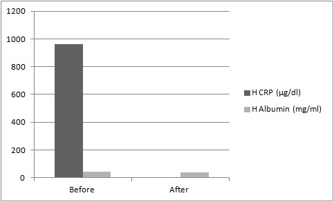 Human C-Reactive Protein (CRP) Deficient Plasma (Heparin)