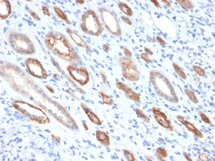 Formalin-fixed, paraffin-embedded human Renal Cell Carcinoma stained with Occludin Mouse Monoclonal Antibody (OCLN/2181).