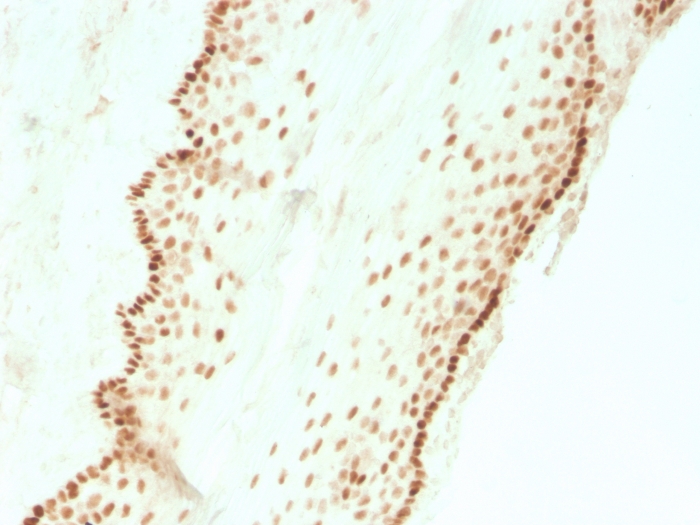 Formalin-fixed, paraffin-embedded human cervical carcinoma stained with SOX2 Recombinant Rabbit Monoclonal Antibody (SOX2/3811R).