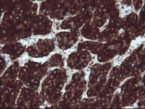 Immunohistochemical staining of paraffin-embedded Carcinoma of Human liver tissue using anti-BTLA mouse monoclonal antibody. Heat-induced epitope retrieval by EDTA solution buffer pH 8.0 at 120°C for 3 min.