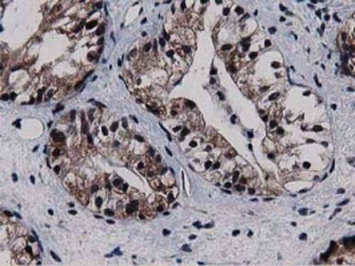 Immunohistochemical staining of paraffin-embedded Adenocarcinoma of Human ovary tissue using anti-SQSTM1 mouse monoclonal antibody. Heat-induced epitope retrieval by EDTA solution buffer pH 8.0 at 120°C for 3 min.