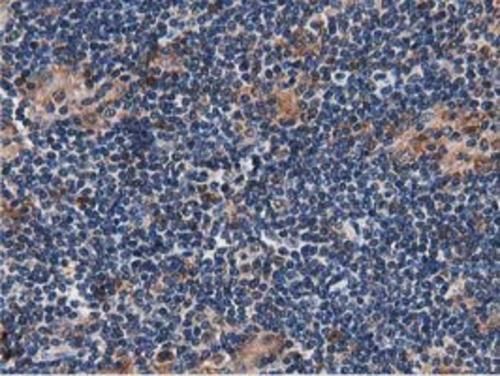 Immunohistochemical staining of paraffin-embedded Human lymphoma tissue using anti-SQSTM1 mouse monoclonal antibody. Heat-induced epitope retrieval by EDTA solution buffer pH 8.0 at 120°C for 3 min.