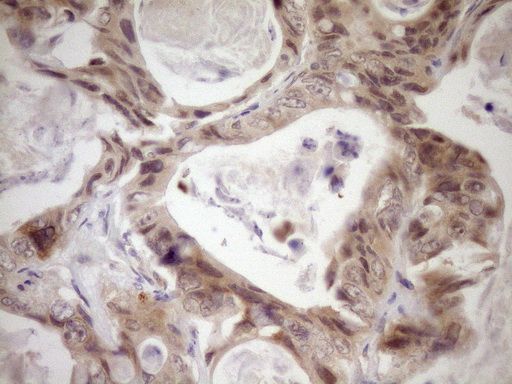 Immunohistochemical staining of paraffin-embedded Adenocarcinoma of Human colon tissue using anti-LAG3 mouse monoclonal antibody. Heat-induced epitope retrieval by EDTA solution buffer pH 8.0 at 120°C for 3 min.