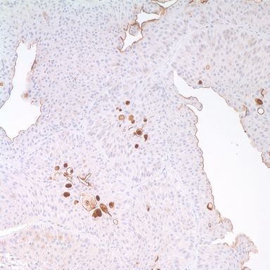 Immunohistochemistry staining of Paraffin Bladder tissue by Uroplakin III antibody (dilution: 1:25 - 1:100; visualization of staining: Membranous, cytoplasmic)