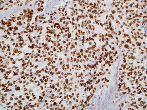 Immunohistochemistry staining of Paraffin Melanoma, ASPS tissue by TFE3 antibody (dilution: 1:50 - 1:200; visualization of staining: Nuclear)