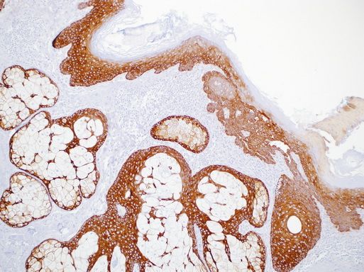Immunohistochemistry staining of Paraffin Mesothelioma, prostate tissue by Cytokeratin 5 antibody (dilution: 1:50 - 1:200; visualization of staining: Cytoplasmic)