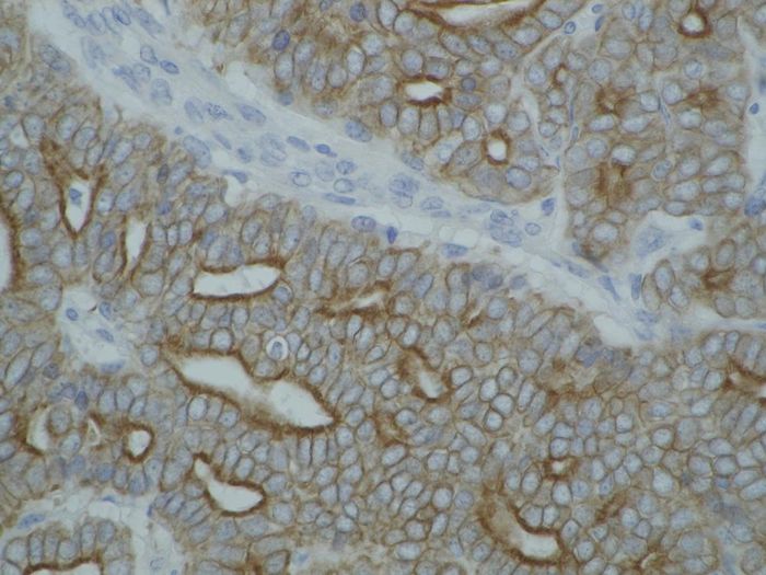 Detection of cytokeratin on paraffin-embedded sections of guinea pig breast carcinoma using anti-cytokeratin antibody (C-11).