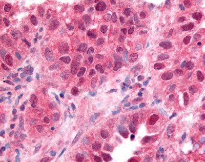 Lung small cell carcinoma: Formalin-Fixed Paraffin-Embedded (FFPE)