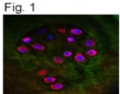Immunocytochemistry/Immunofluorescence: Aggrecan Neoepitope Antibody TA336492 - Detection of ACAN in OA cartilage using TA336492.