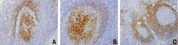 Immunohistochemical staining of paraffin-embedded human tonsil using FCER2 (CD23) clone UMAB101, mouse monoclonal antibody at 1:400 dilution of 1mg/mL using Polink2 Broad HRP DAB for detection. UM800031 requires heat-induced epitope retrieval with citrate pH6.0 at 110°C for 3min using pressure chamber/cooker. The image is a composite of 3 tonsils which show strong membranous and cytoplasmic staining however each tonsil has a unique expression pattern in the inner and outer germinal center.
