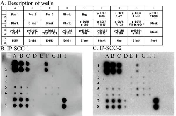 RayBiotech's EGFR Phosphorylation Antibody Array revealed key EGFR phosphorylation sites in carcinoma arising from inverted papilloma. Figure adapted from Hirakawa et al., Journal of Personalized Medicine, 2023.