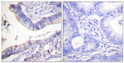 Immunohistochemistry analysis of paraffin-embedded human colon carcinoma tissue, using BCL-2 Antibody. The picture on the right is blocked with the synthesized peptide.
