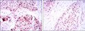 Immunohistochemistry analysis of paraffin-embedded lung cancer tissues (left) and esophageal cancer tissues (right) with DAB staining using SOX-2 monoclonal antibody.