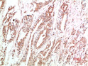 Immunohistochemical analysis of paraffin-embedded Human Stomach Carcinoma Tissue using VEGF Rabbit pAb diluted at 1:500.