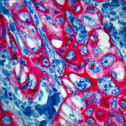 Formalin fixed paraffin embedded squamous cell carcinoma human tissue stained with CK 5/6 antibody (Mob362) labeled with PermaRed AutoPlus (K057) produces a brilliant red color.