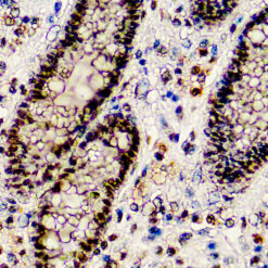 Formalin fixed paraffin embedded human breast carcinoma stained with BAP1