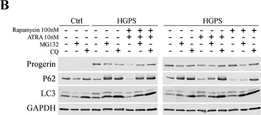 All-trans retinoic acid and rapamycin normalize Hutchinson Gilford progeria fibroblast phenotype.