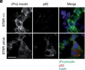 Lysosomal degradation of newly formed insulin granules contributes to β cell failure in diabetes.