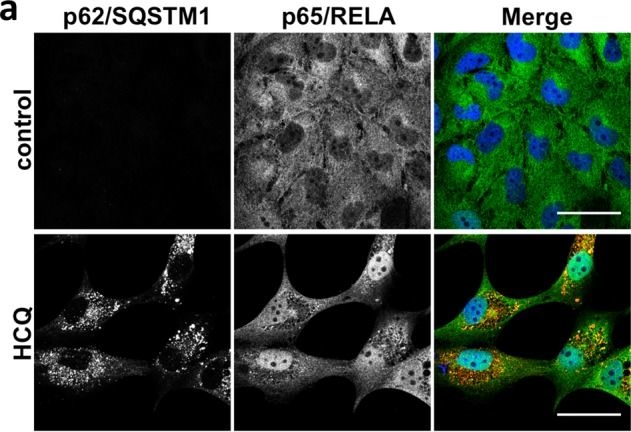 Autophagy inhibition-mediated epithelial-mesenchymal transition augments local myofibroblast differentiation in pulmonary fibrosis.