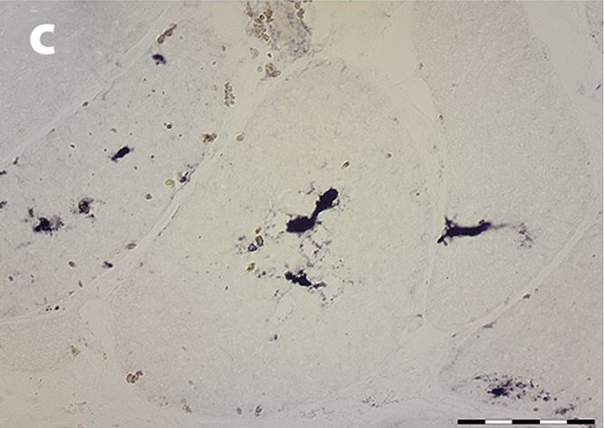 Myoglobinopathy is an adult-onset autosomal dominant myopathy with characteristic sarcoplasmic inclusions.