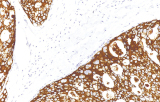 Anti-HER2/neu CE/IVD para IHC - Patologia ginecológica