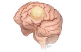 Cancer du cerveau