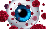 Cancer oculaire