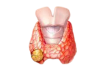 Cancer de la thyroïde