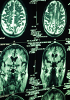 ADNc du cerveau humain
