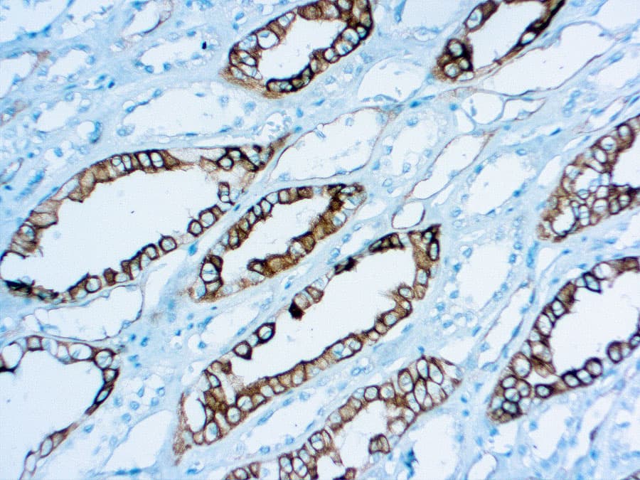 Inphographie Rcc Anti-Renal Cell Carcinoma (RCC) CE/IVD pour IHC - pathologies uro